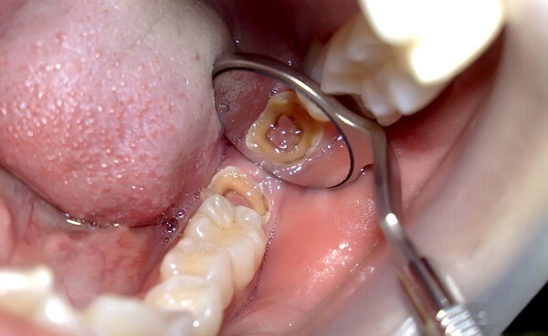 tooth extraction painful implanting wait before