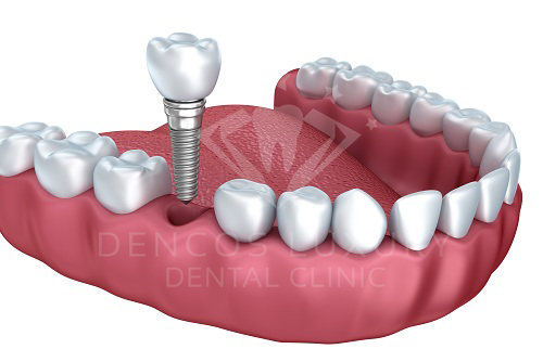 Advanced technology dental implant placement