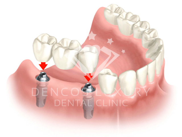 All the details to consider when placing dental implants